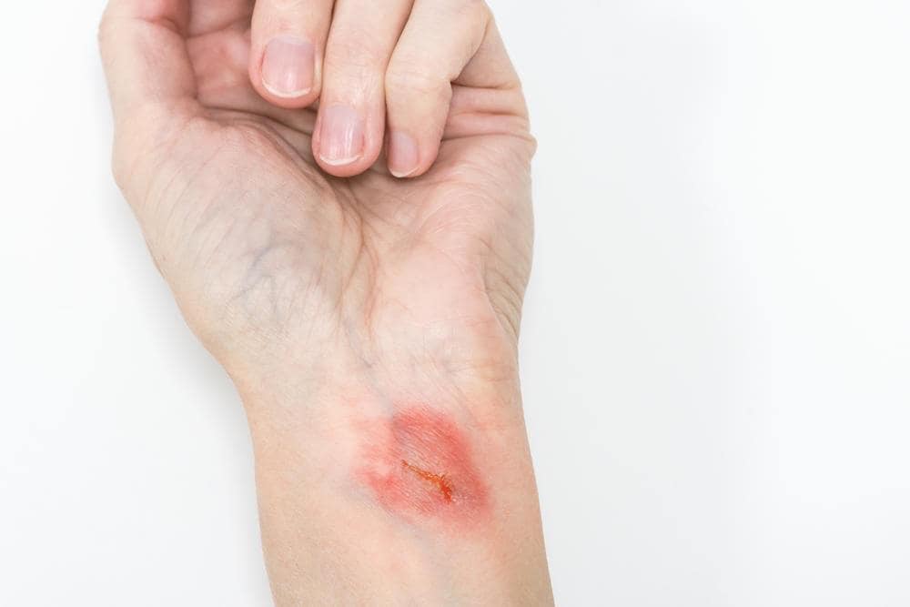mẹo trị bỏng tại nhà